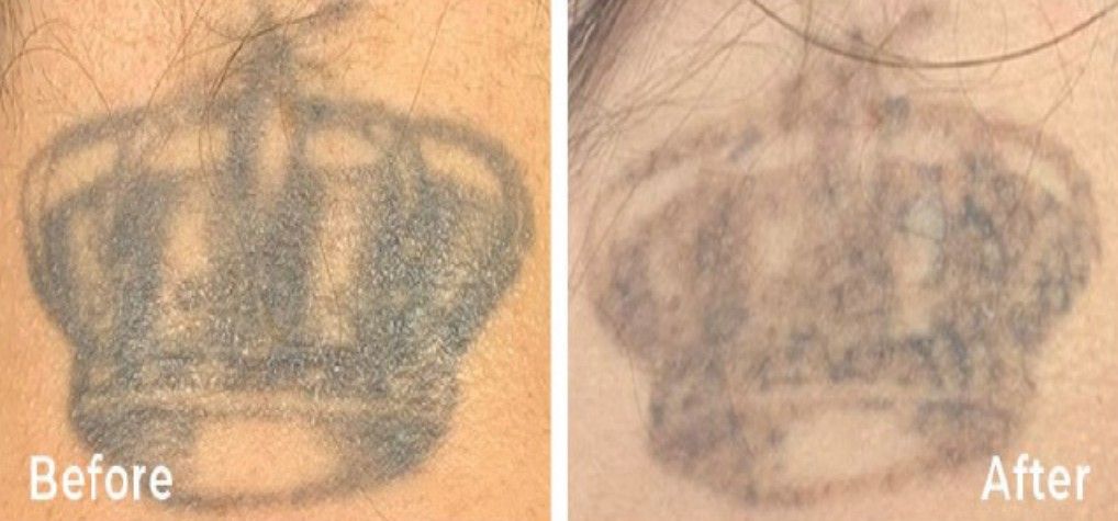 Before and after images of tattoo removal on skin. A dark crown tattoo is faded after treatment.