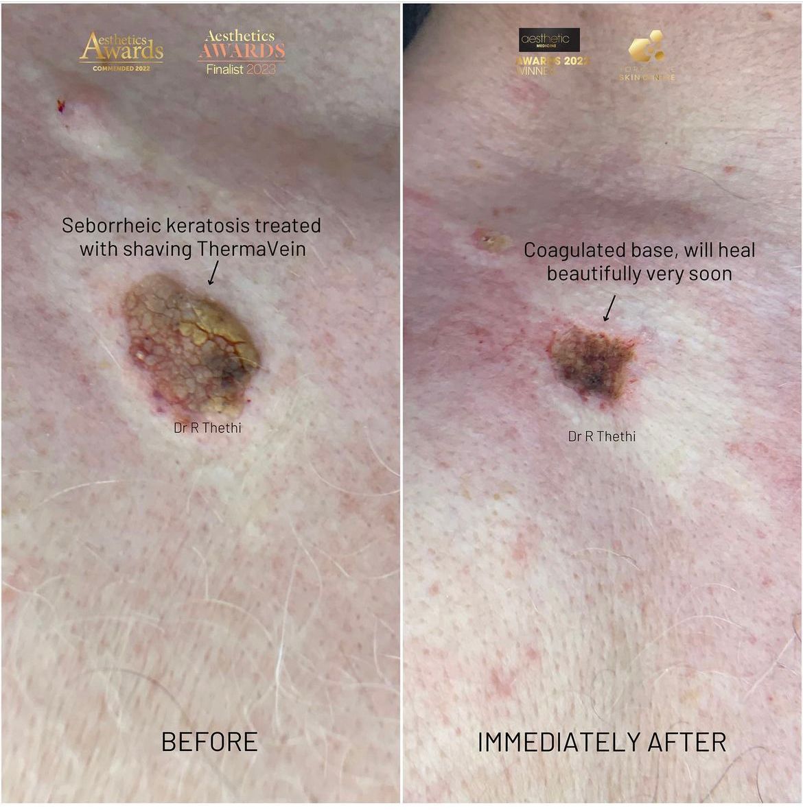 Aesthetic Treatment Results Gallery Yorkshire Skin Centre Aesthetic Treatment Results Gallery Yorkshire Skin Centre