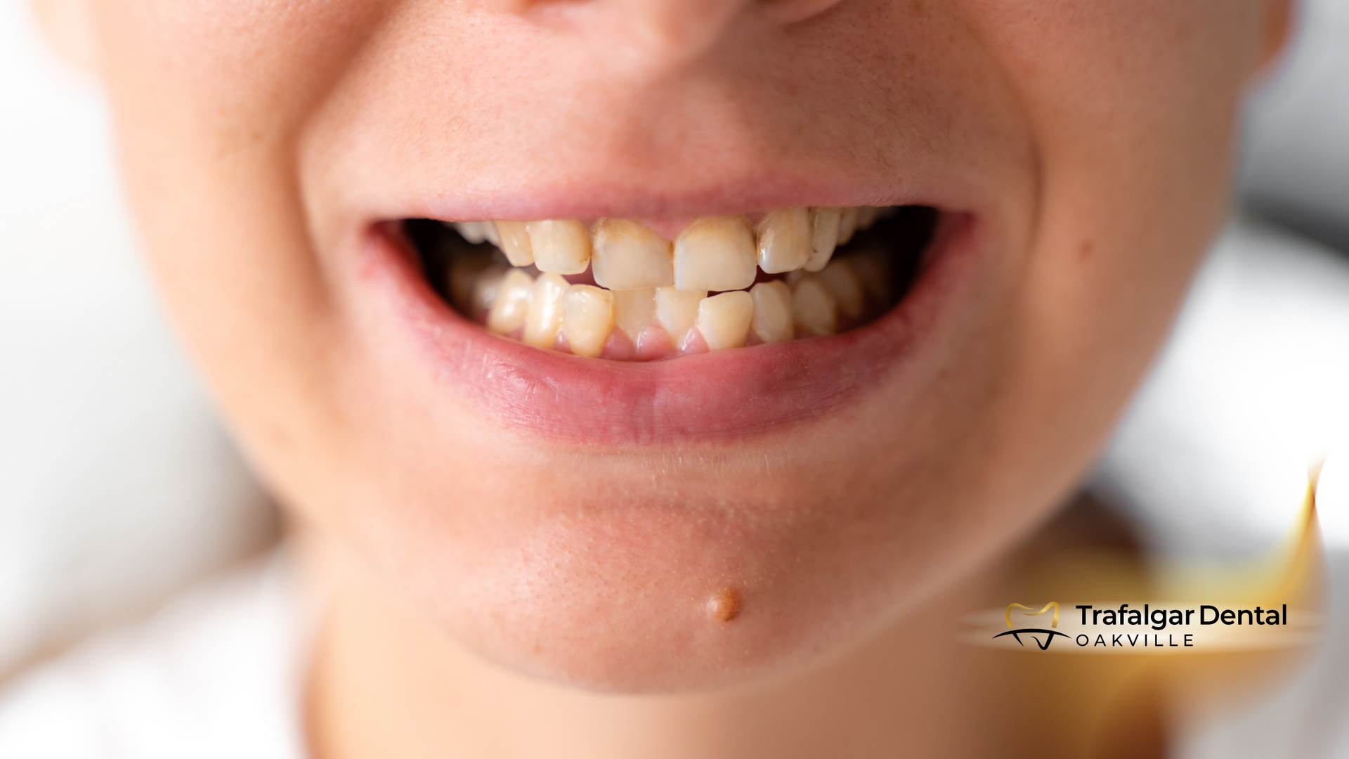 Close-up of a person's mouth showing crooked, discolored teeth; slight smile.