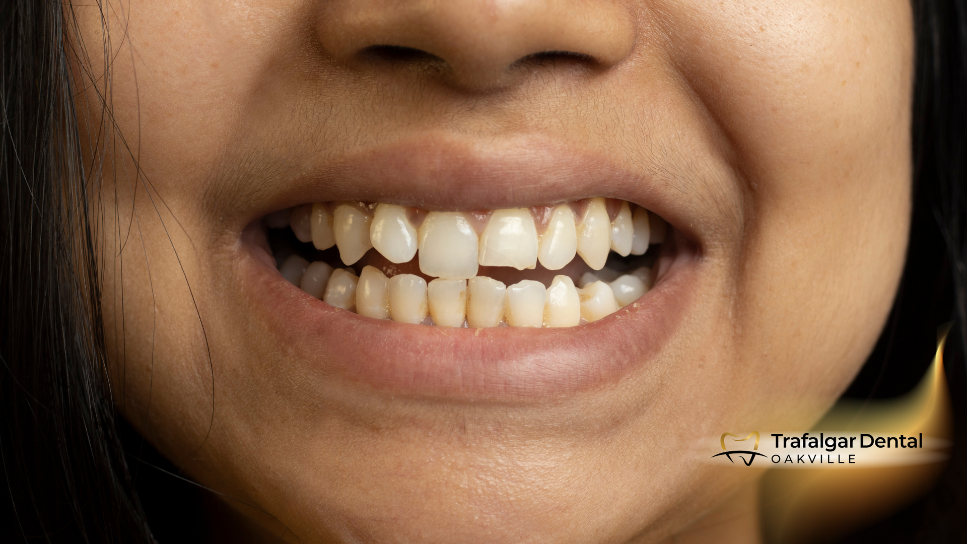 A close up of a woman 's teeth with a missing tooth.
