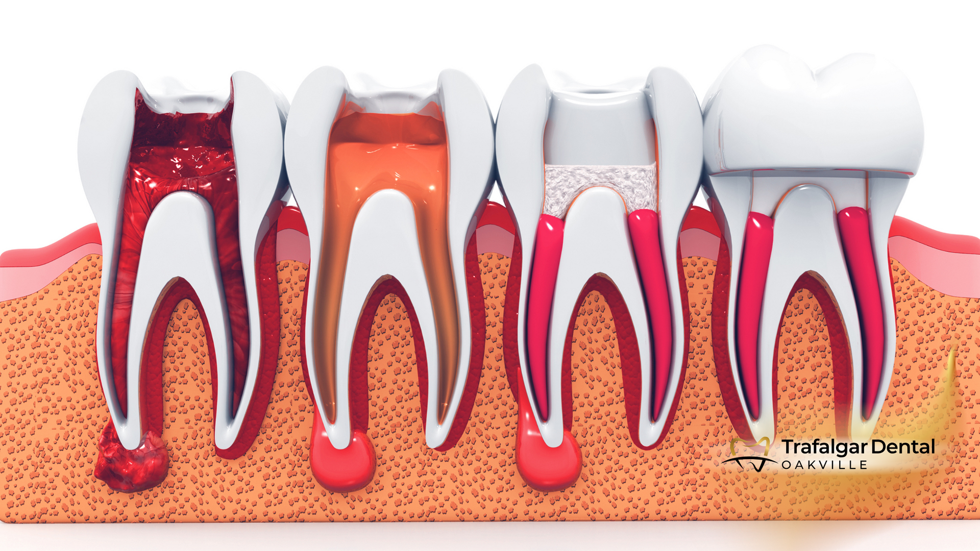 Cross-section of teeth showing various stages of decay and fillings, in an orange gum line.