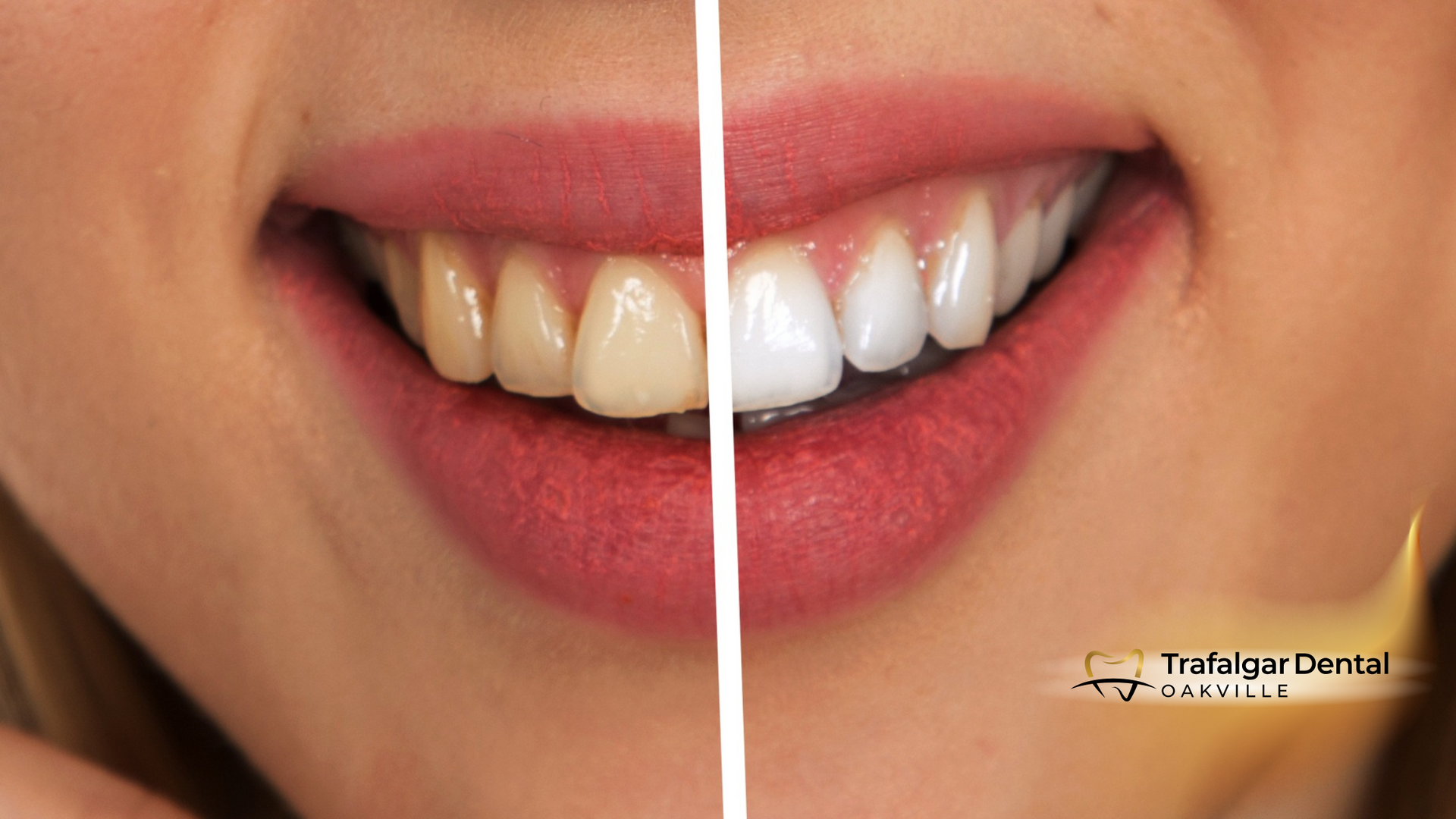 Split image shows teeth before and after whitening; before: yellowed, after: white.