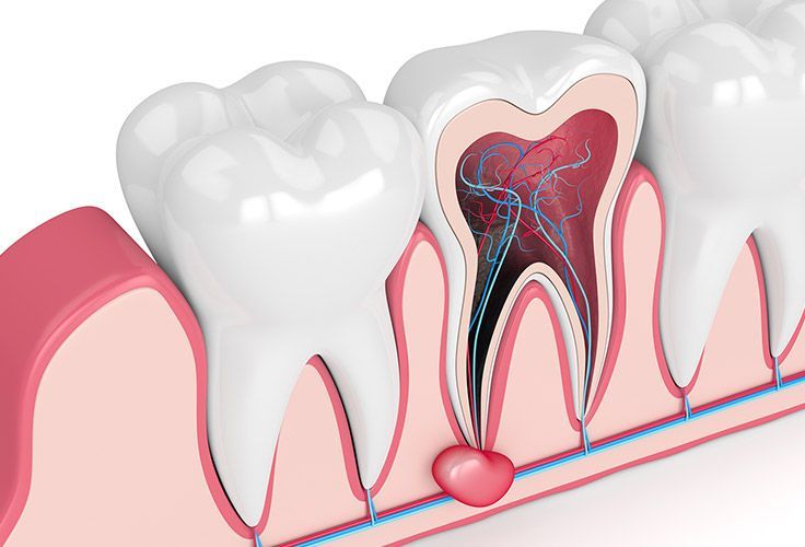 A close up of a tooth with a hole in it.