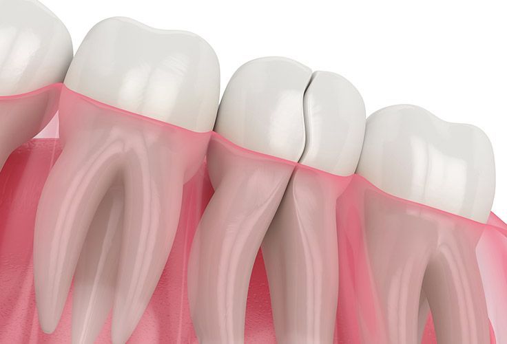 A 3d rendering of a broken tooth in a row of teeth.