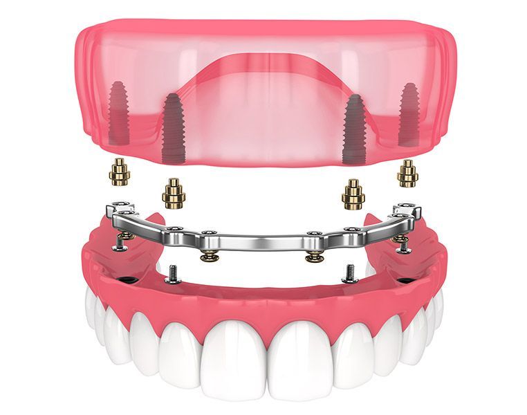 A 3d rendering of a full denture with dental implants.