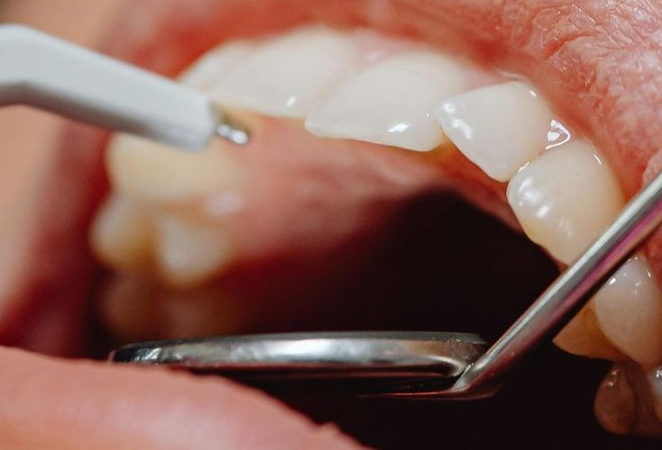 A person is getting their teeth examined by a dentist