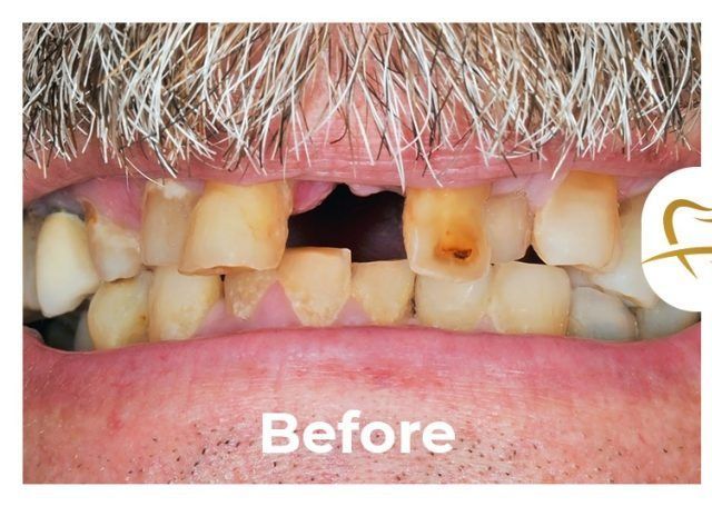 A man with a beard has a missing tooth in his mouth.