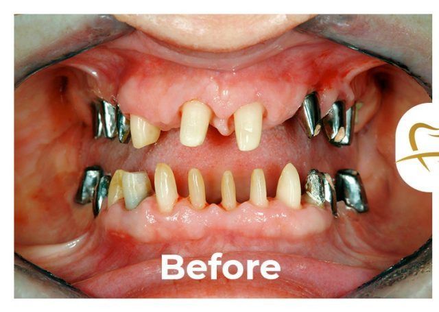 A picture of a person 's teeth before dental work