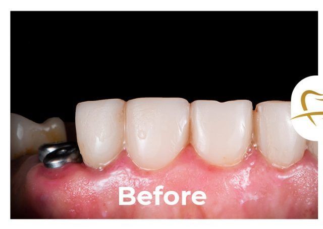 A picture of a person 's teeth before a dental treatment.