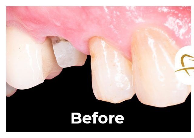A picture of a person 's teeth before a dental procedure.