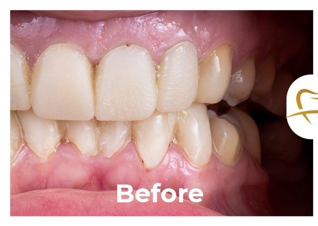 A picture of a person 's teeth before a dental treatment