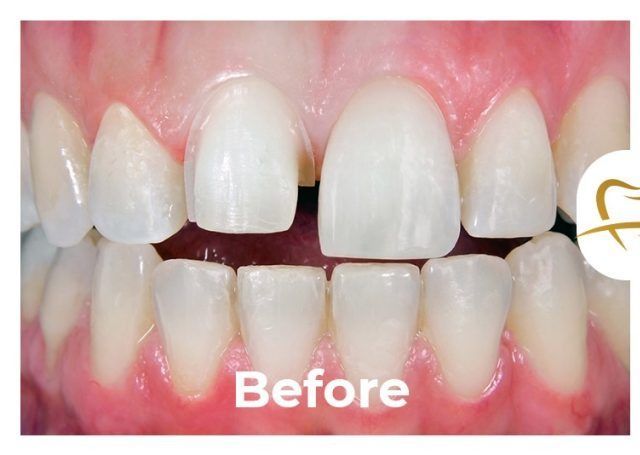 A picture of a person 's teeth before a dental treatment.
