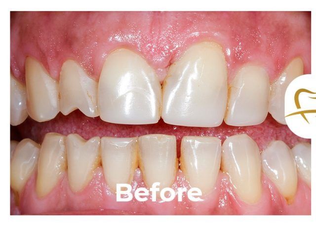 A close up of a person 's teeth before a dental treatment.