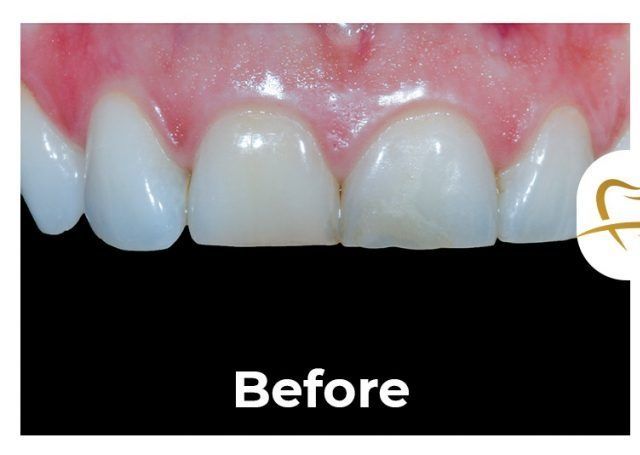 A picture of a person 's teeth before a dental treatment.