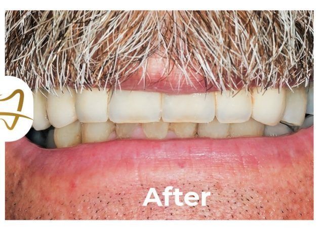 A man with a beard has a picture of his teeth after dental treatment.