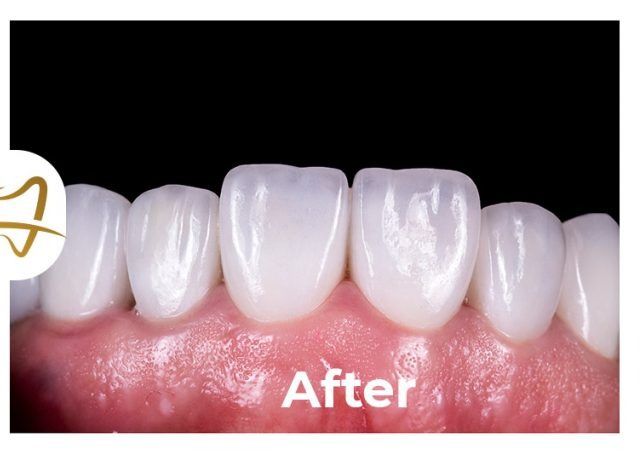 A close up of a person 's teeth with the words after on the bottom.