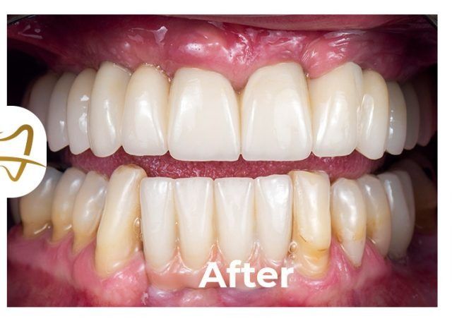 A close up of a person 's teeth with the words after on the bottom