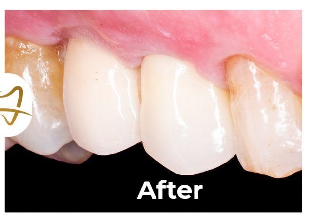 A close up of a person 's teeth with the words after on the bottom