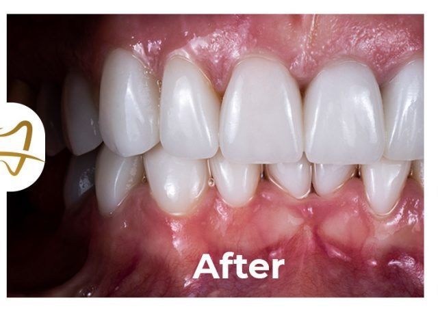 A close up of a person 's teeth after a dental treatment.