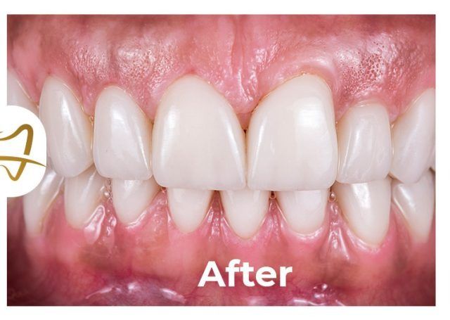 A close up of a person 's teeth after a dental treatment.