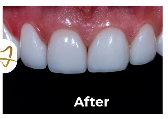 A close up of a person 's teeth with the words after on the bottom