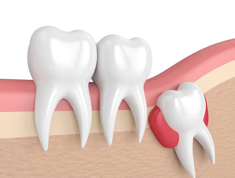 A 3d rendering of a tooth with a wisdom tooth growing out of it.