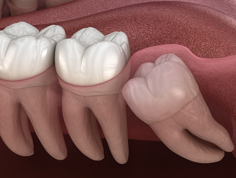 A computer generated image of a person 's teeth and gums.