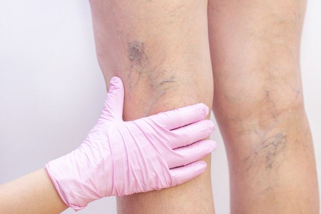 Medical Vein Treatments in Westminster