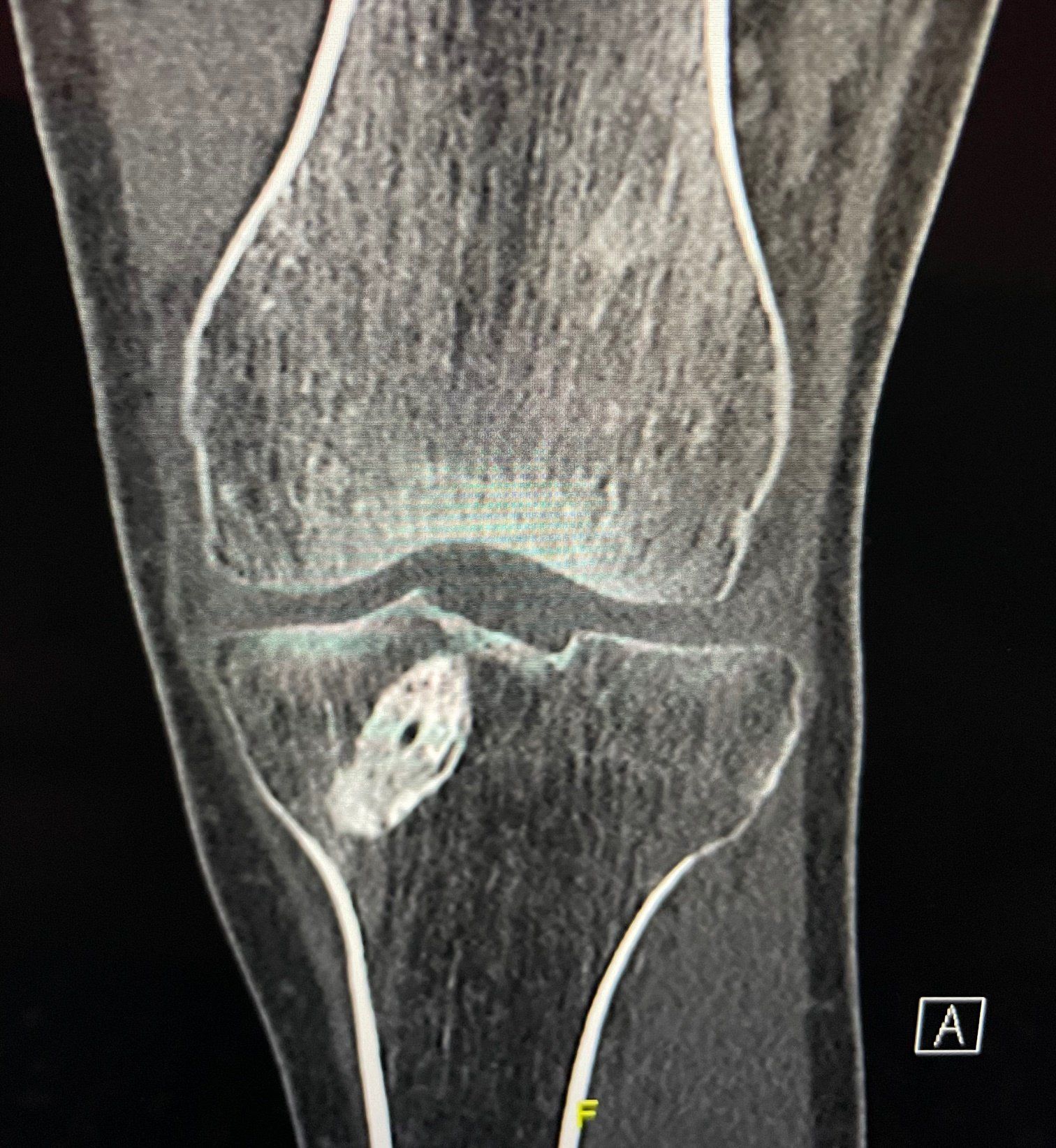 ACL Reconstruction Using Bone Allograft CT Knee Images