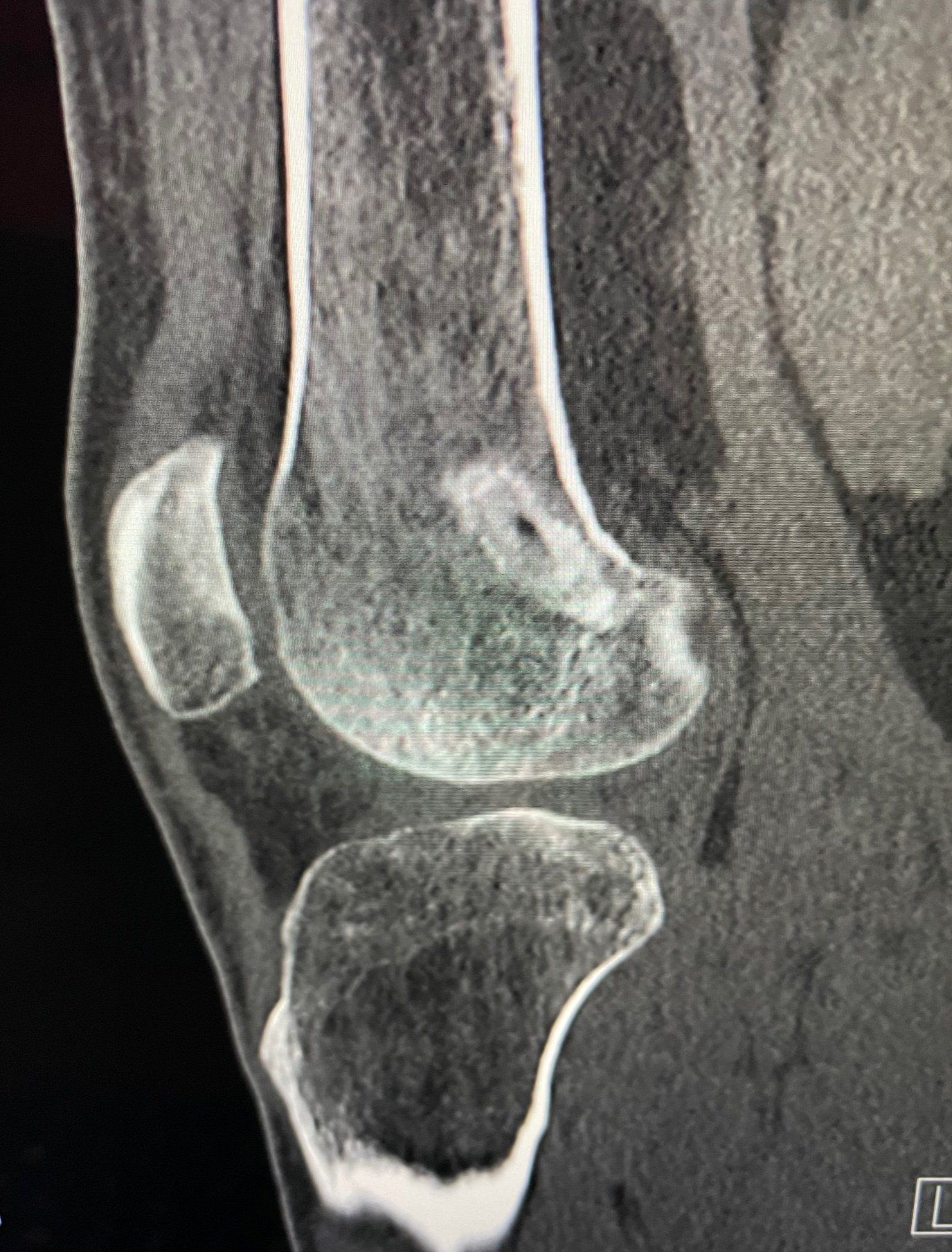 A ct scan of a knee showing a broken knee joint.