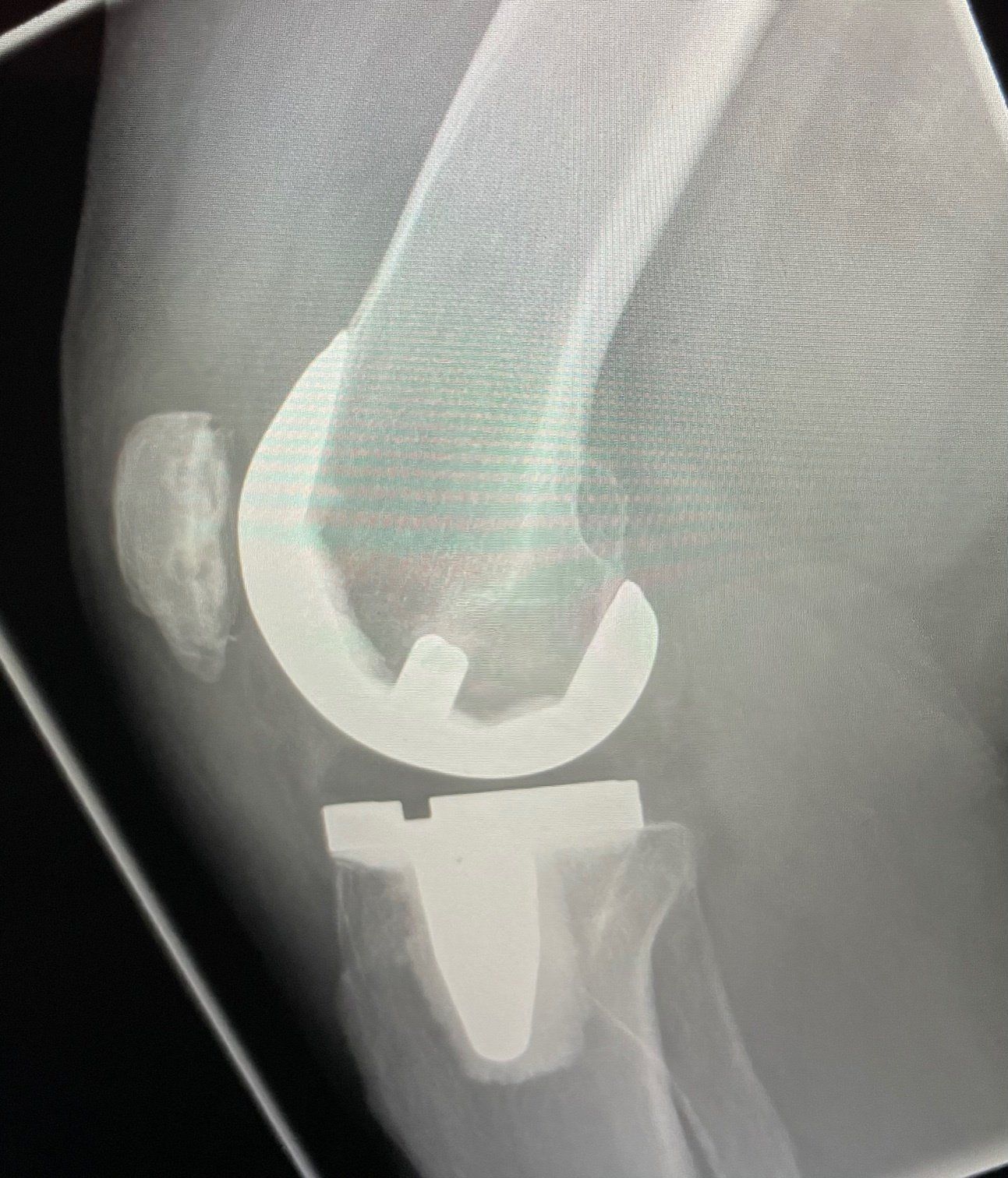 An x-ray of a knee with a prosthetic knee joint.