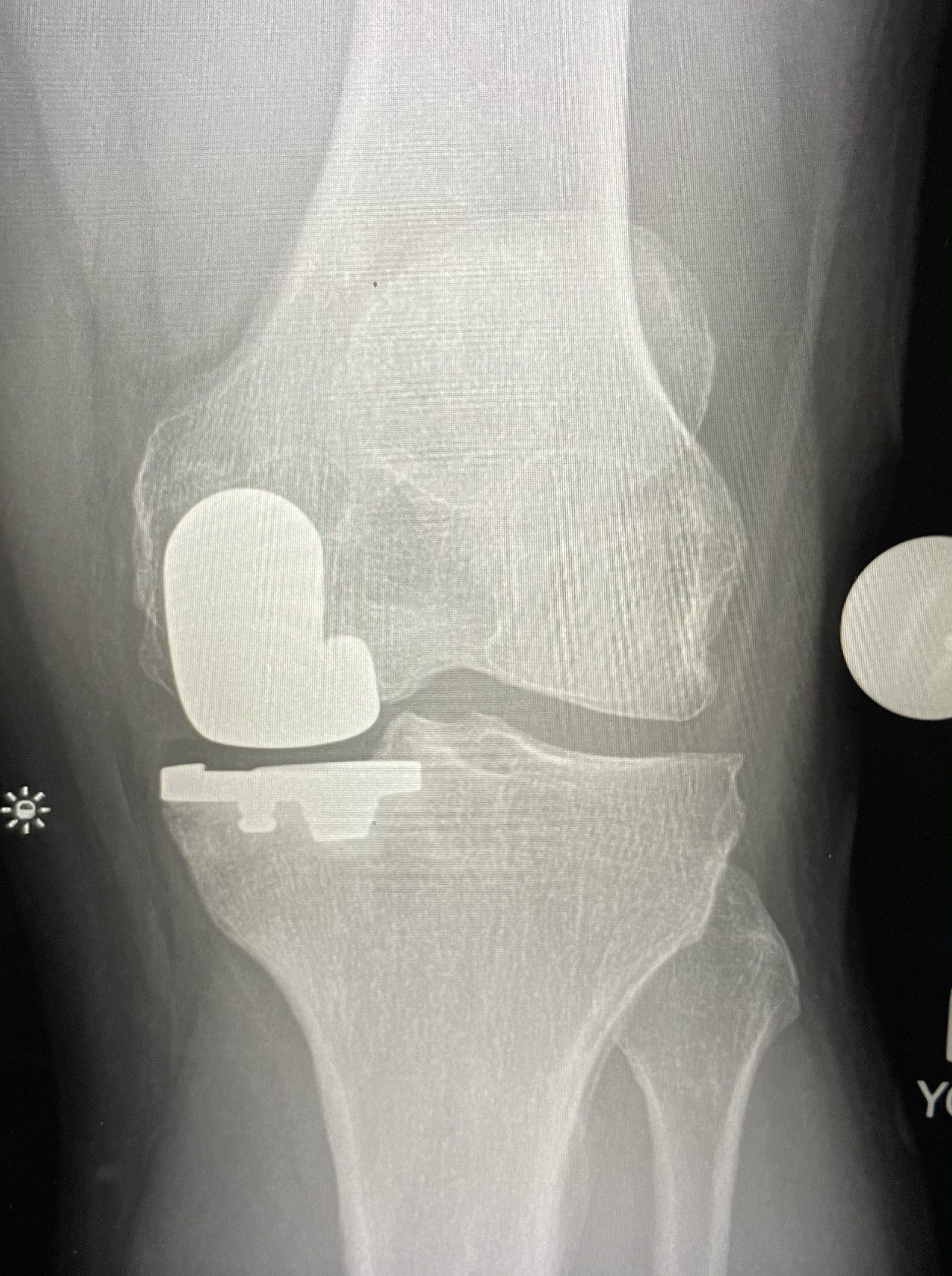 An x-ray of a knee with a prosthetic knee joint.