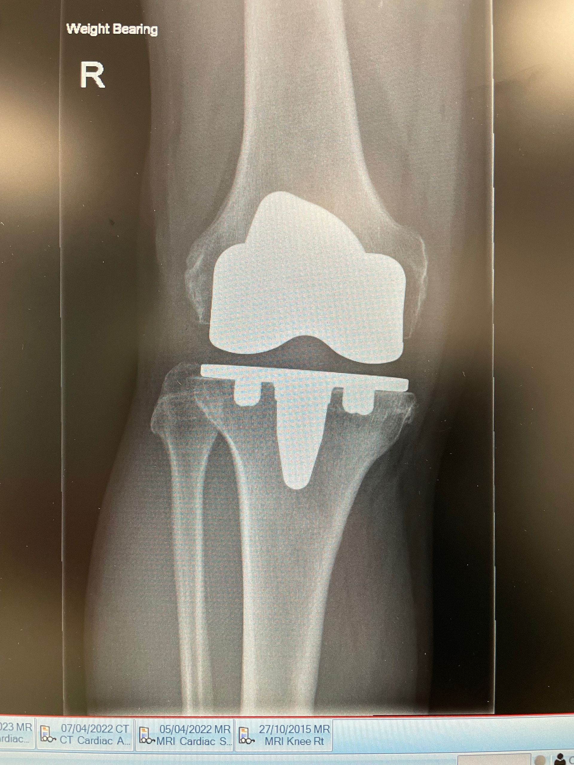 X-Rays of knee surgery