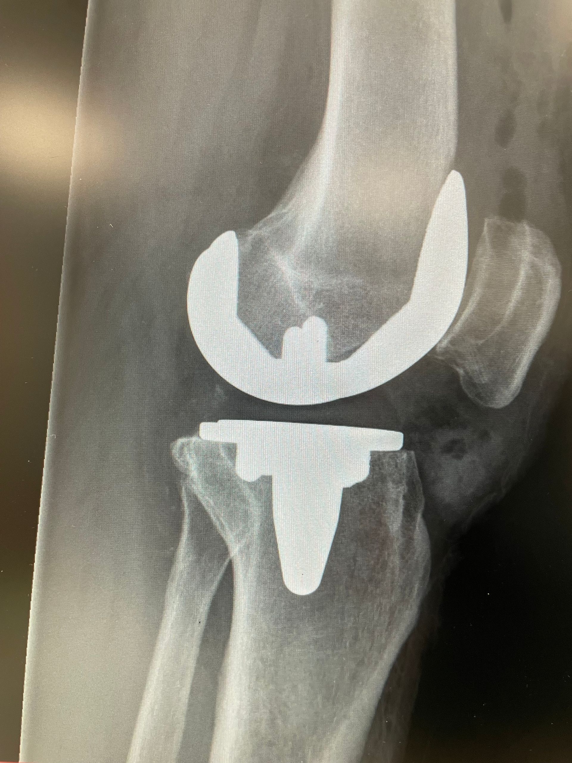 X-Rays of knee surgery