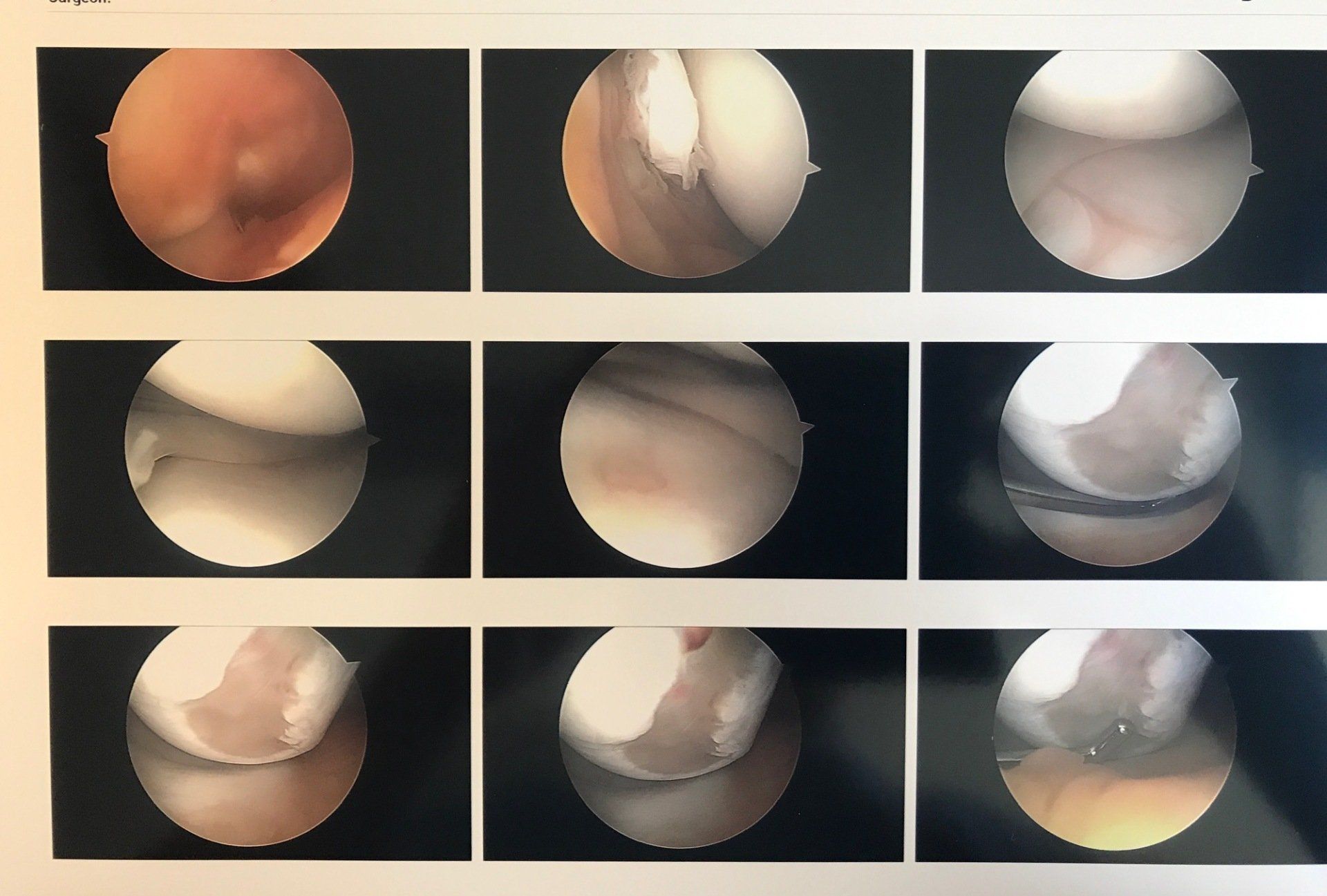 A series of images of a knee showing different stages of surgery