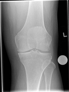 An x-ray of a person 's knee with a hole in it.