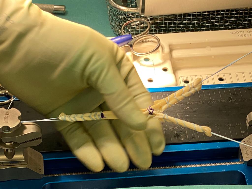 A person wearing gloves is holding a needle in their hand