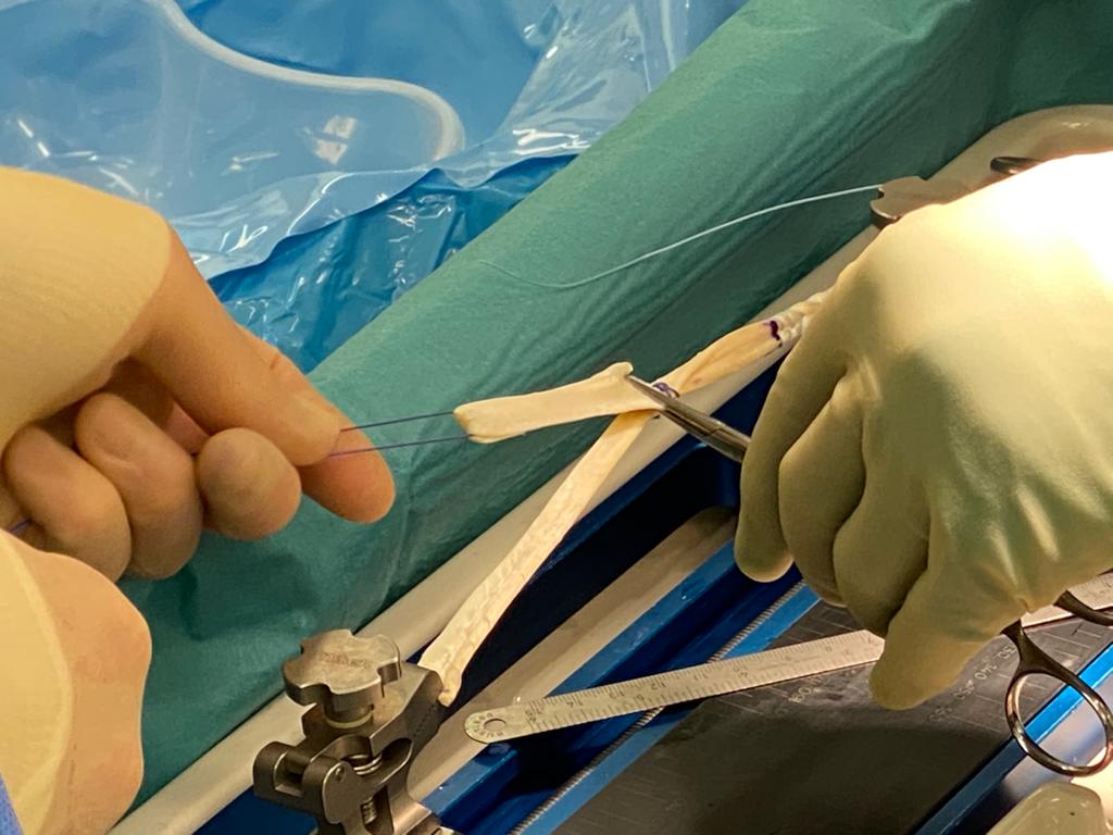 A surgeon is cutting a piece of bone with a pair of scissors