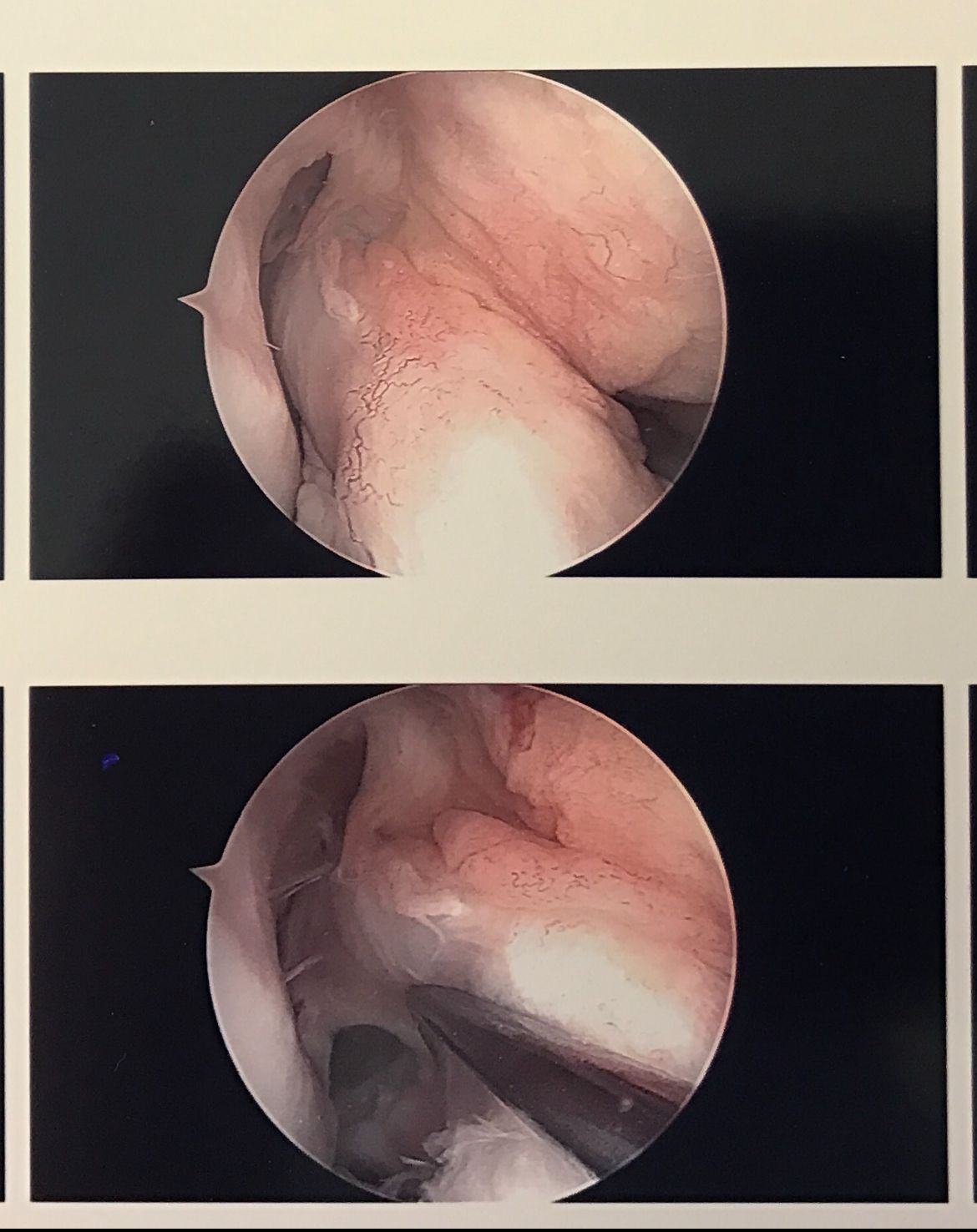 Scan images of a ACL surgery