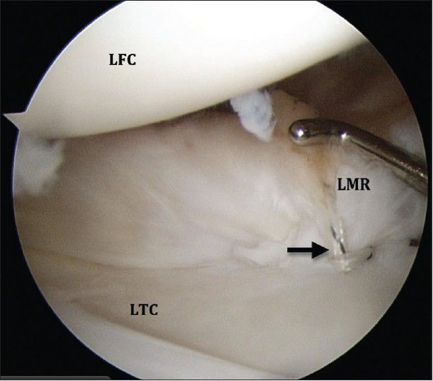 Scan images of a Meniscal surgery