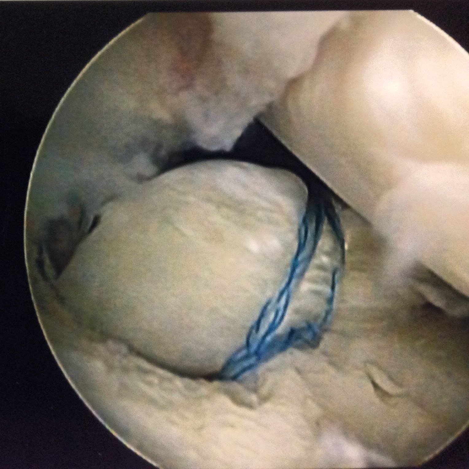 Scan images of a Meniscal surgery