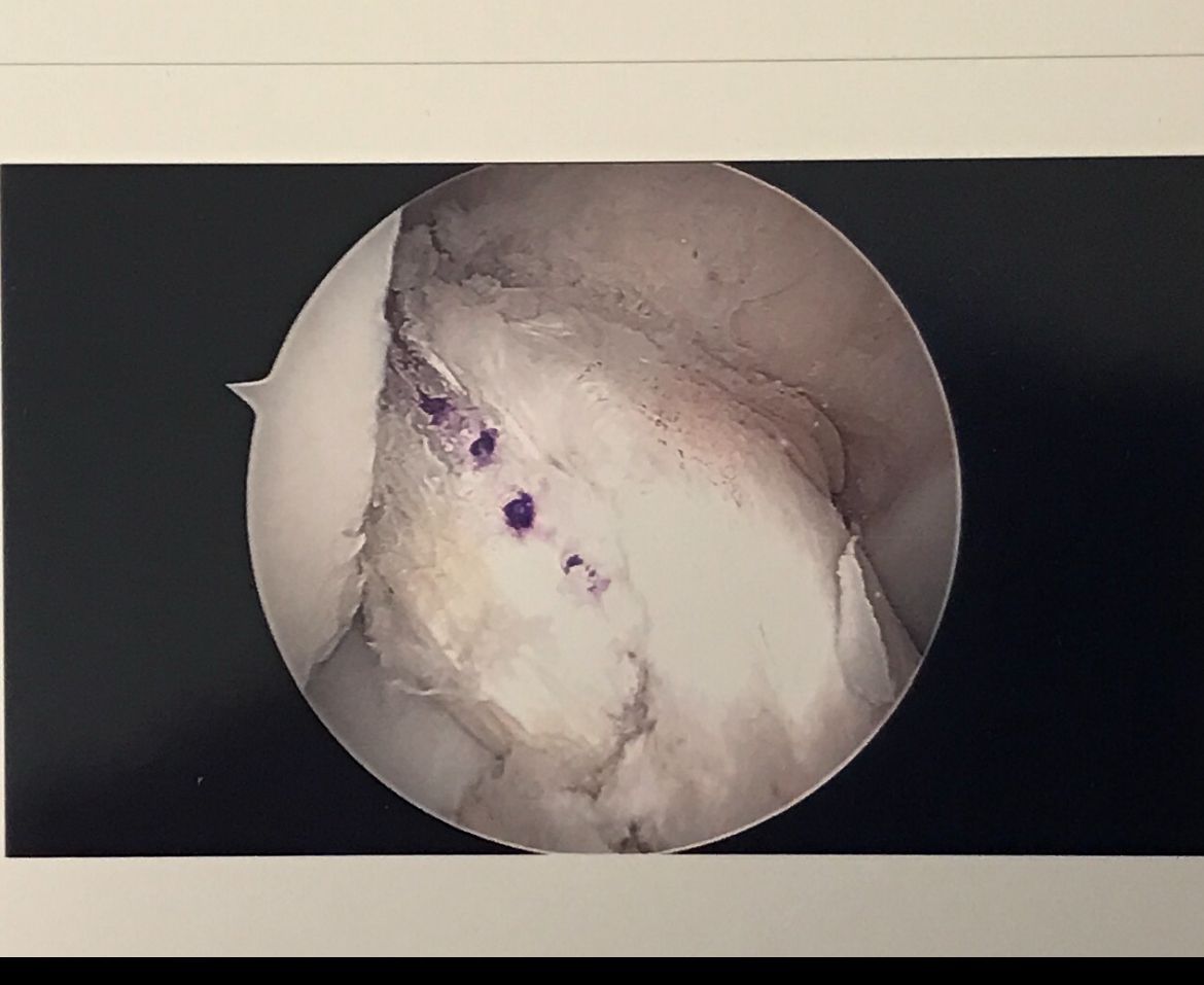 Scan images of a ACL surgery
