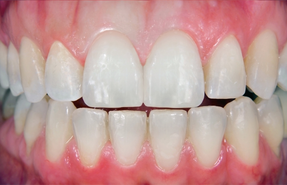 chipped tooth, discolored tooth, discoulered tooth