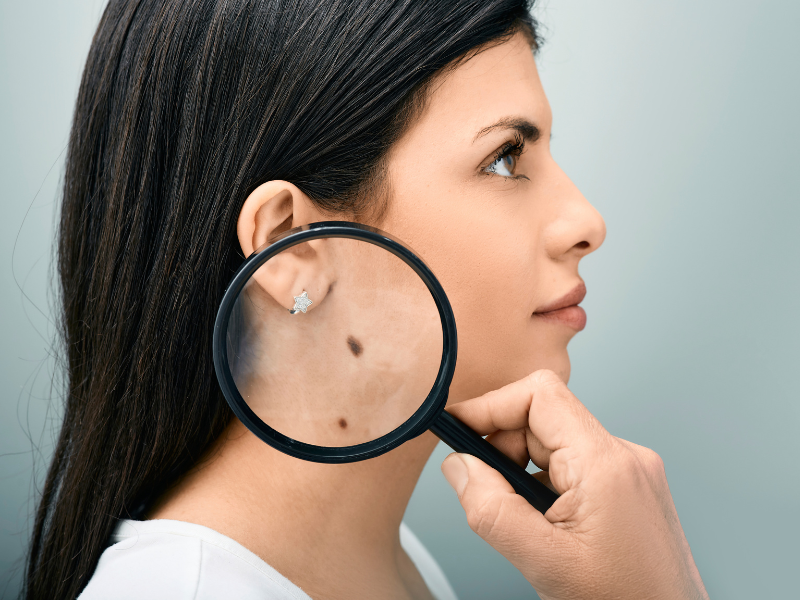 A woman is looking at a mole on her face through a magnifying glass.