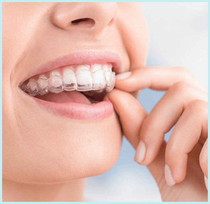 A woman is wearing clear braces on her teeth.