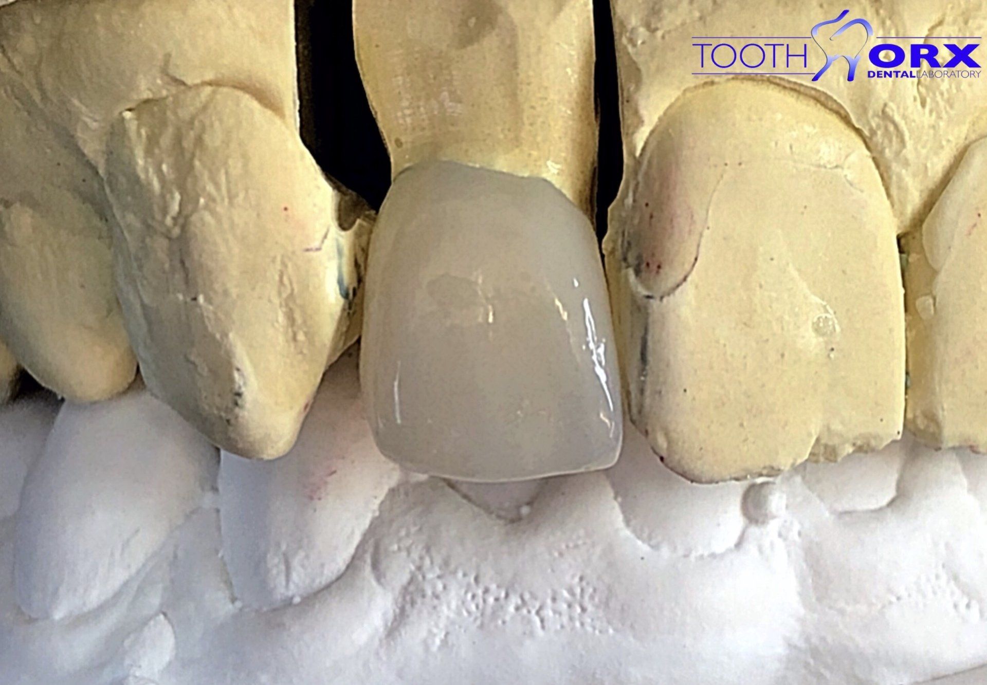 Ivoclar Emax Ceram Layered To Zirconia