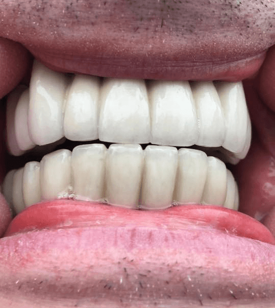 Porcelain Bonded Bridge implants dental dentistry cardiff wales