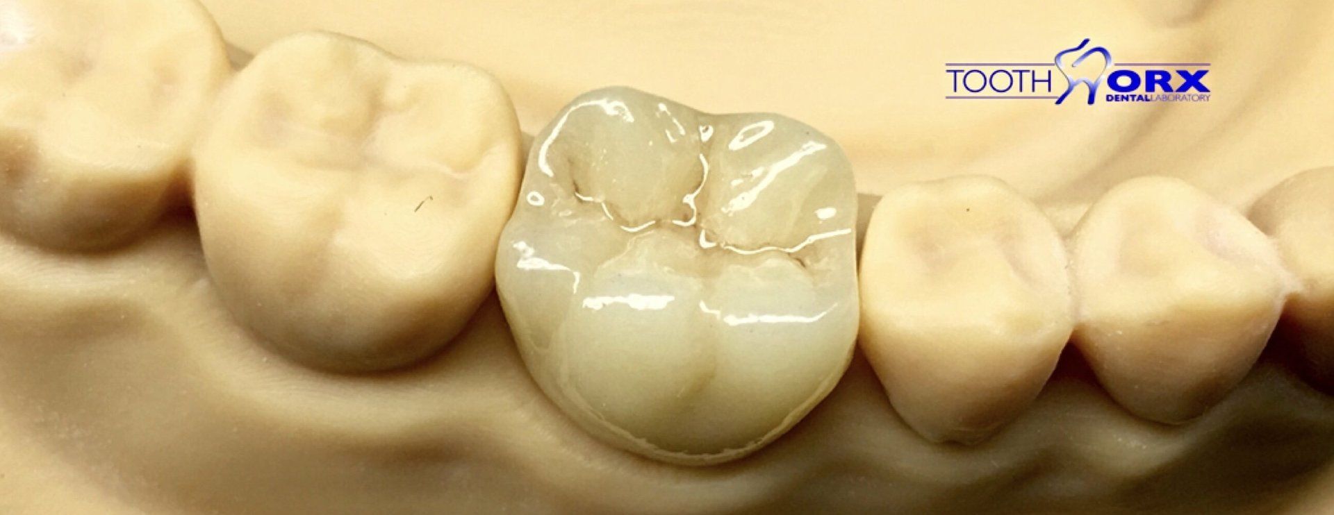 emax ivoclar crowns bridges cardiff dental dentistry
