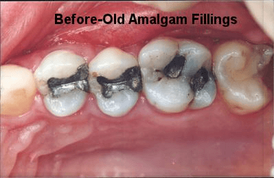 Before-Old Amalgam Fillings - Dentistry in Pleasant Hill, MO
