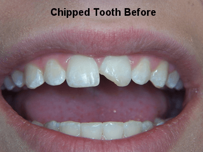 Chipped Tooth Before - Dentistry in Pleasant Hill, MO